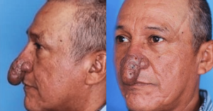 Conrado’s Nose: An Astonishing Transformation